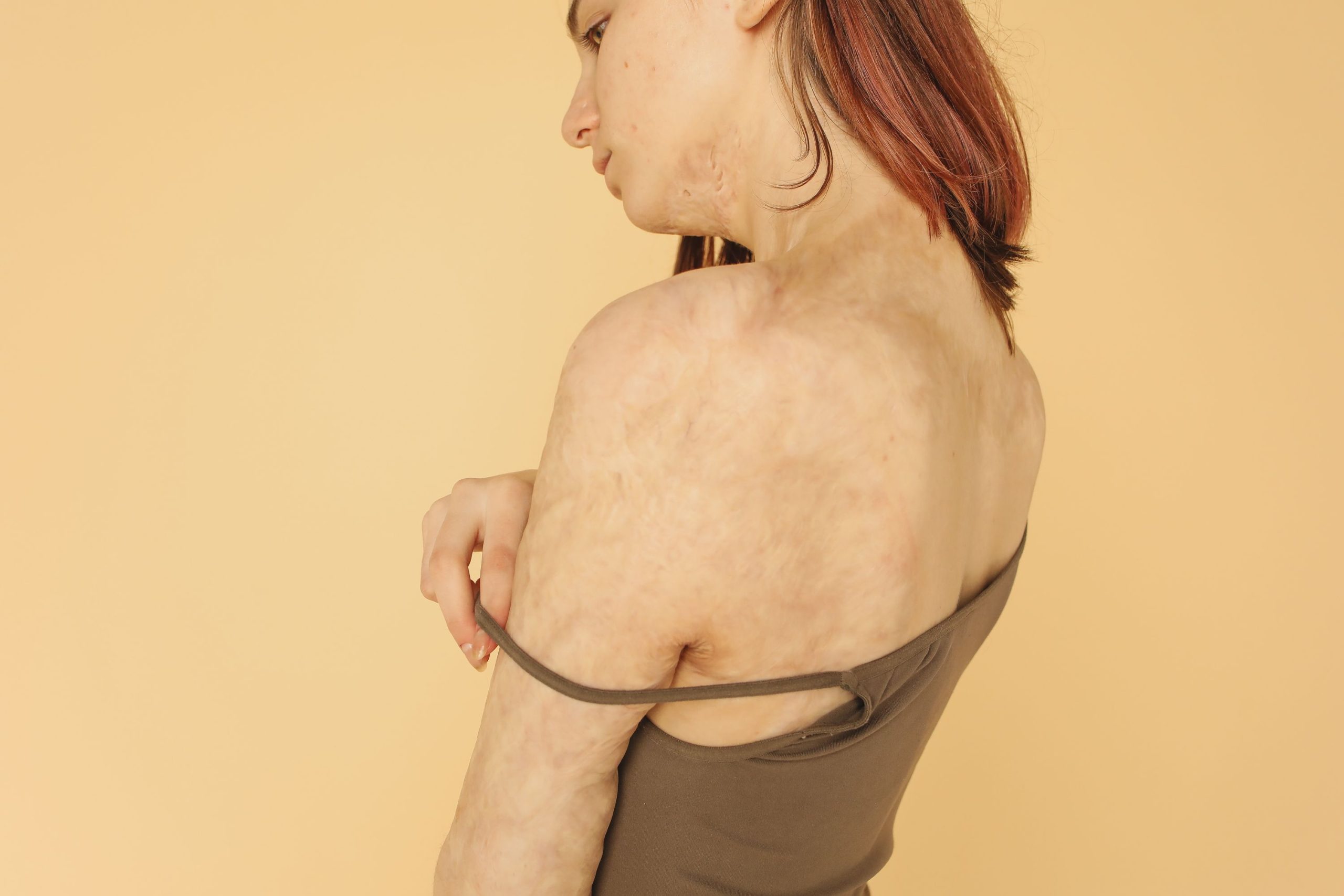 Tipos de irritación de la piel y cómo aliviar sus molestias